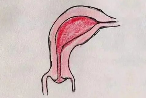 單角子宮能正常生育嗎？單角子宮對懷孕的影響